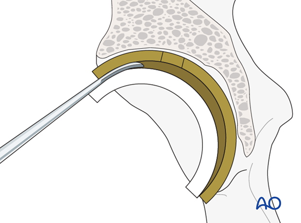 Use of an osteotome at the liner-cup junction to lever and to remove the liner