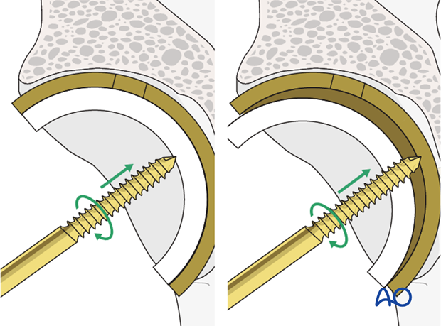 Use of a threaded extraction tool or cancellous screw to push out the liner