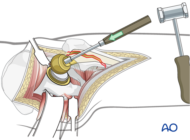 Disengage the femoral head from the Morse taper of the femoral prosthesis