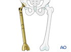 fracture proximal to loose femoral component and poor bone stock