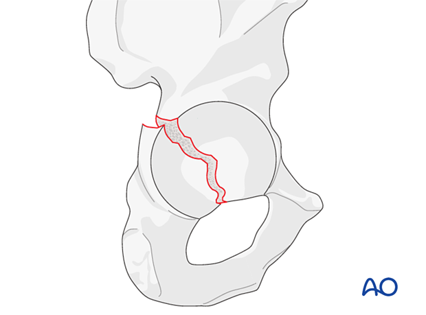 Posterior wall and column fracture