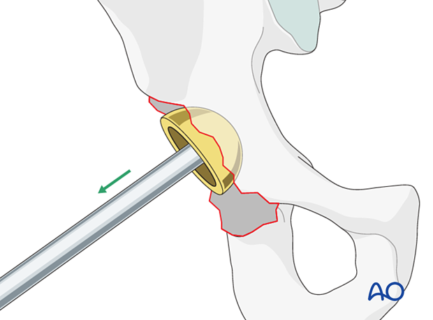 Intraoperative acetabular cup removal