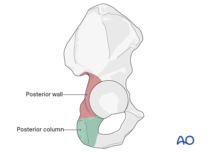 ORIF (plate and screw) of posterior fractures with or without cup ...