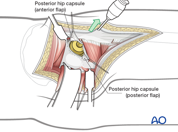 Posterior exposure of the hip