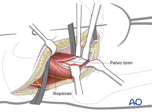 Exposure through open lateral window of the ilioinguinal approach