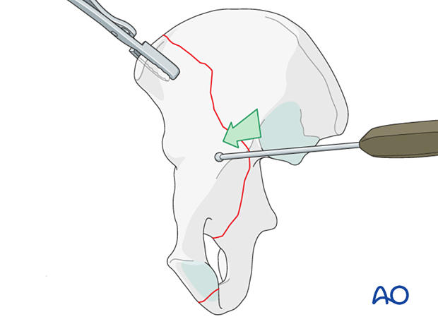 Reduction of the anterior aspect of the joint