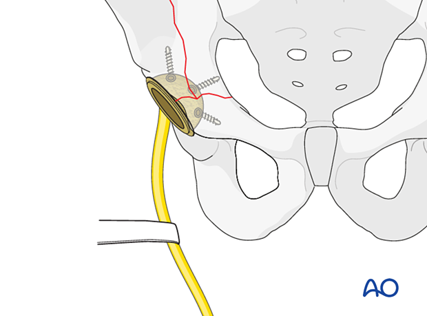 Retraction of the sciatic nerve