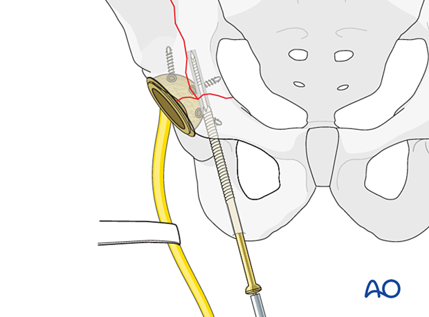 The screw is inserted over the guidewire