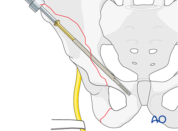 The screw is inserted over the guidewire