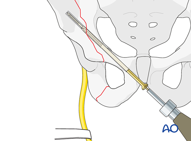 Percutaneous screw insertion
