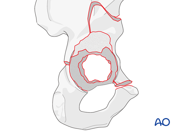 Protrusion through the medial wall of the acetabulum