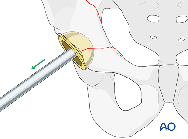 Acetabular component removal for a fracture occurred during cup insertion