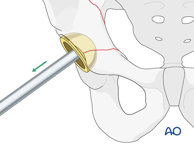 Oref Leg ORIF (plate and screw) of anterior fractures with or without cup ...