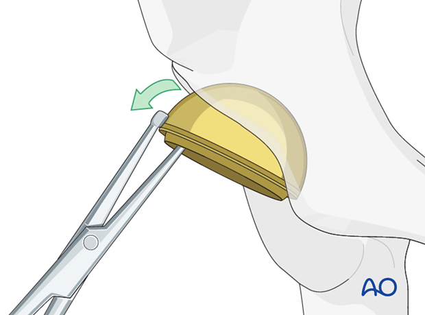 Remove of an acetabular component without screws