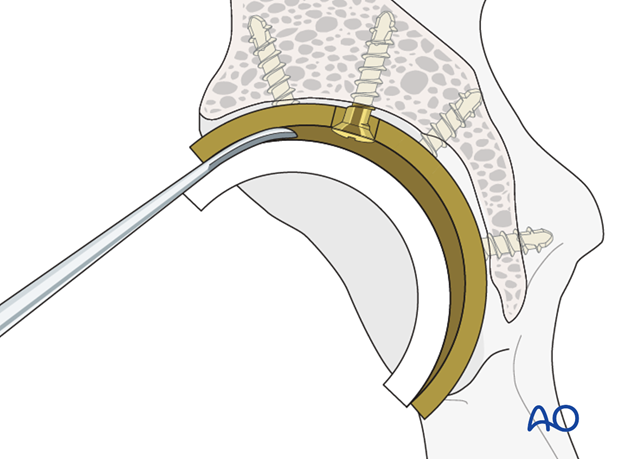 Polyethylene component removal from an acetabular cup
