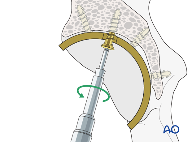 Screw removal from an acetabular cup