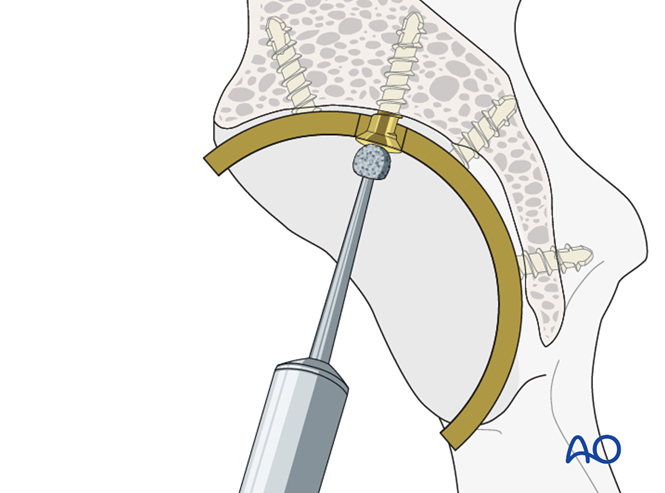 Acetabular cup removal