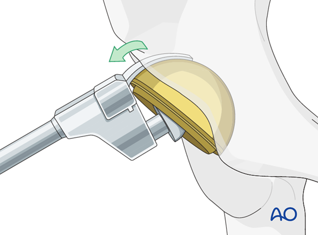 Acetabular osteotome system to disengage the bone/prosthesis interface