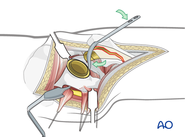Exposure of the acetabular component