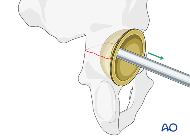 Acetabular component removal