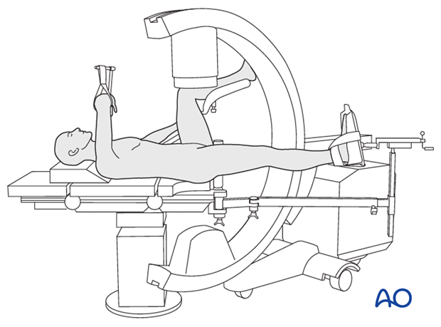 Supine position on a radiolucent table