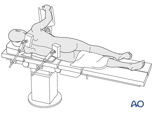OR setup for lateral decubitus positioning