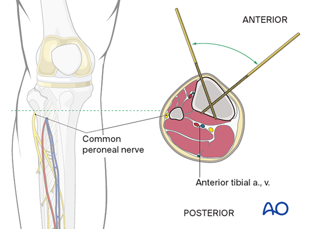 Distal of the tibial tuberosity