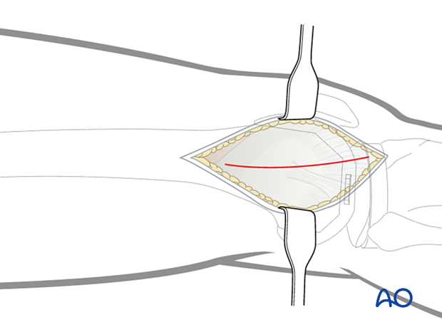 Divide the iliotibial band in line with the skin incision