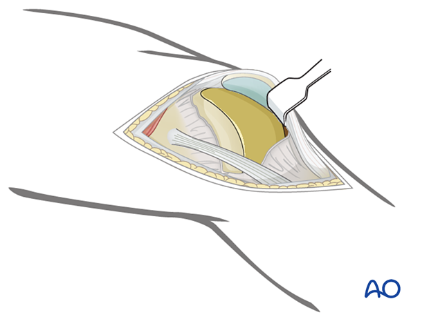 Distally, incise the joint capsule over the anterior third of the lateral femoral condyle