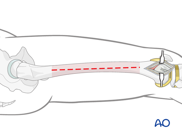 Minimally invasive approach to the midshaft or proximal femoral region