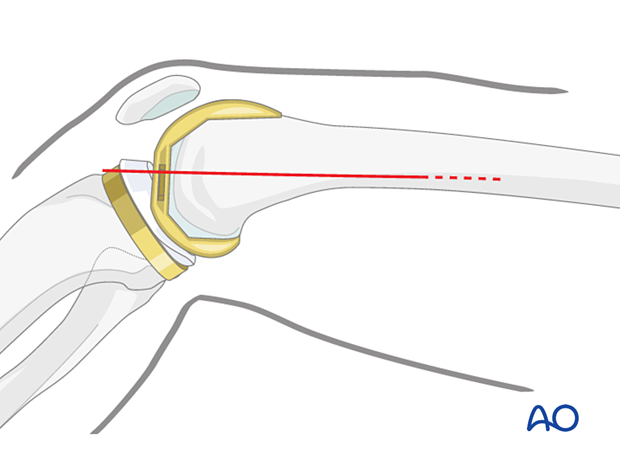 Skin incision made in the line of the tendon of adductor magnus