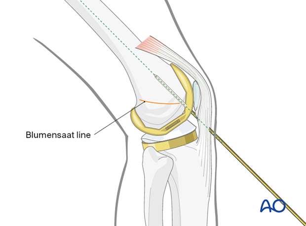 Guide wire insertion