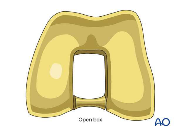 Femoral component with open box design