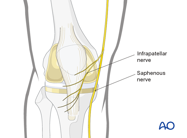 The saphenous nerve runs along the medial aspect of the distal femur