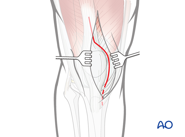 Proximal and distal extensions