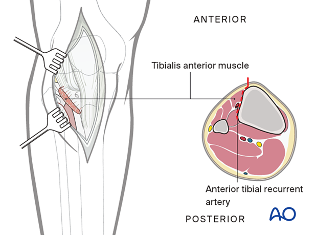 A300 Anterolateral approach proximal tibia