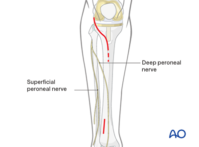 MIO Anterolateral approach to the proximal tibia