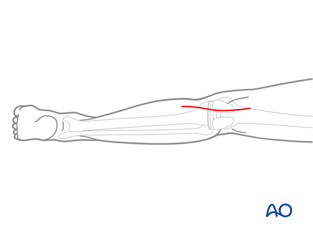 A330 Posteromedial approach proximal tibia
