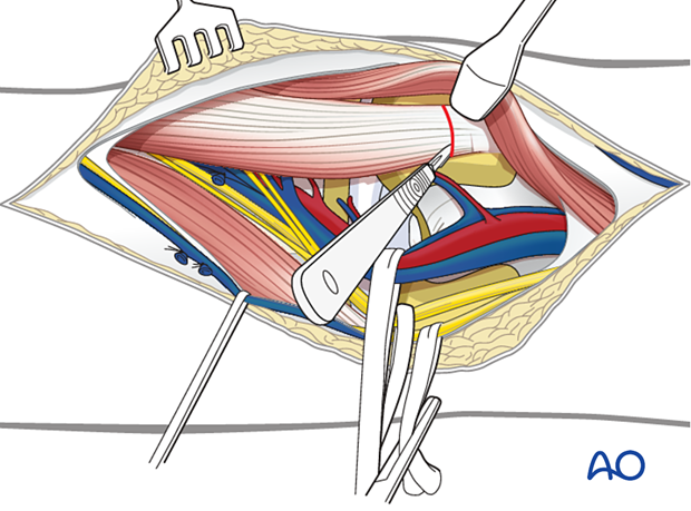 the medial gastrocnemius tendon can be released from the medial femoral condyle
