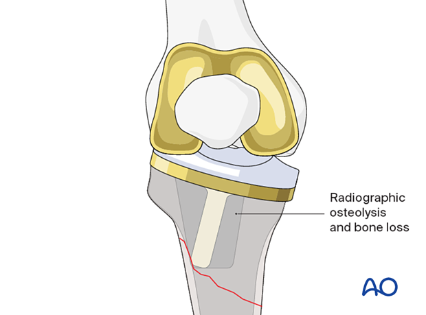 Nondisplaced tibial plateau or tubercle
