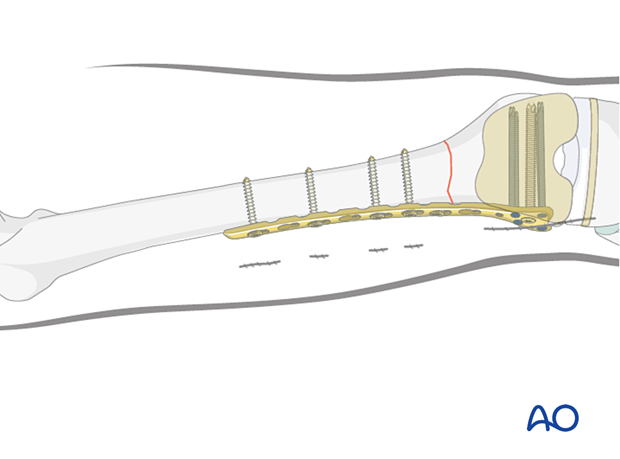 P110 Femur compression plate