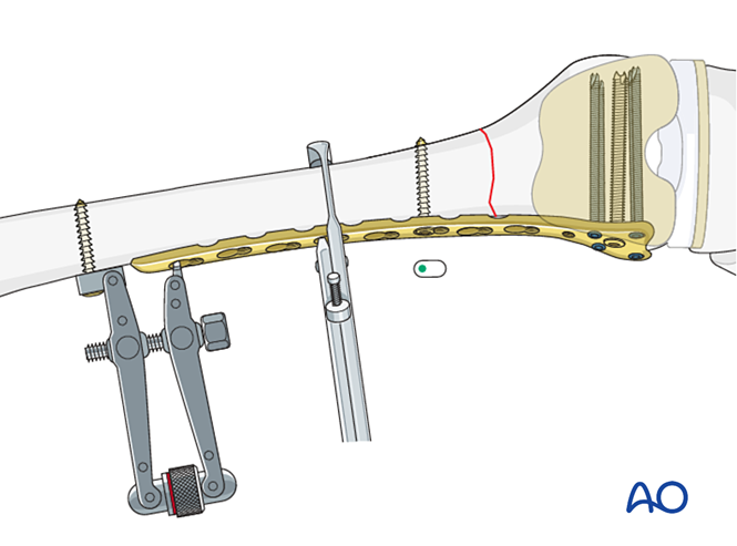Compression plate for Fracture around a stable femoral component with ...