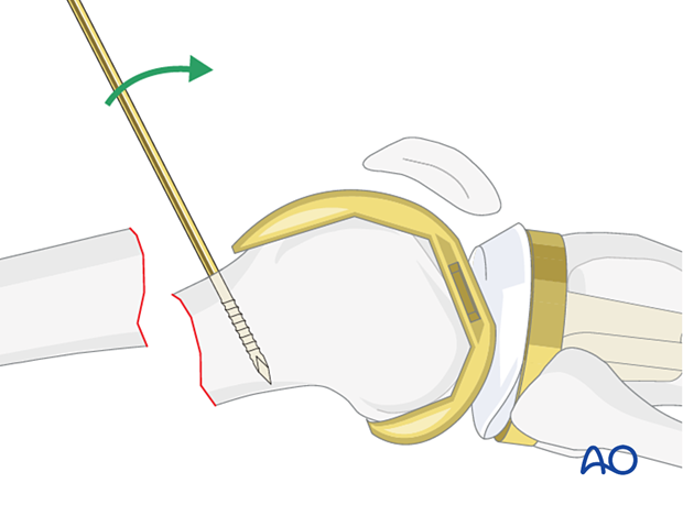a sagittal pin can be used as a joystick in the condylar block