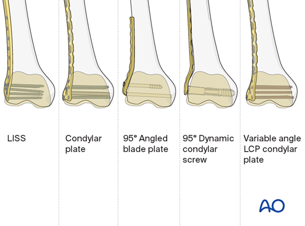 Comparison of distal femur implants