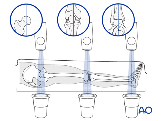 Radiological landmarks for correct alignment