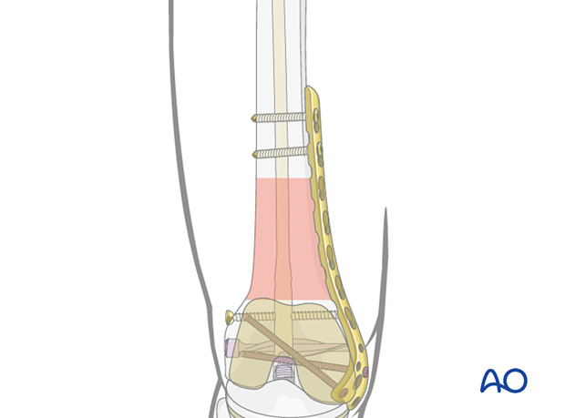 Medial plate applied to the distal femur