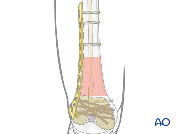 Lateral plate applied to the distal femur