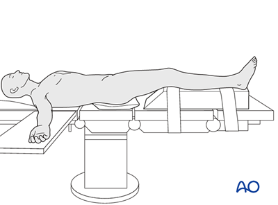 Cerclage compression wiring for Fracture around stable patellar ...
