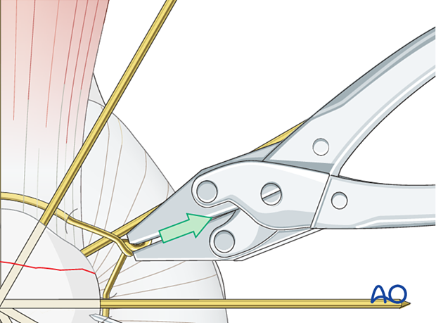 Carefully tighten the wire while pulling away from the patella as the wires are twisted