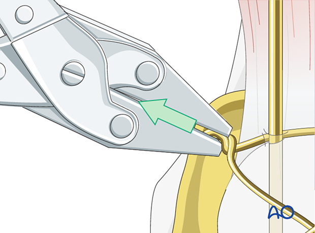 Pull away from the patella as the wires are twisted
